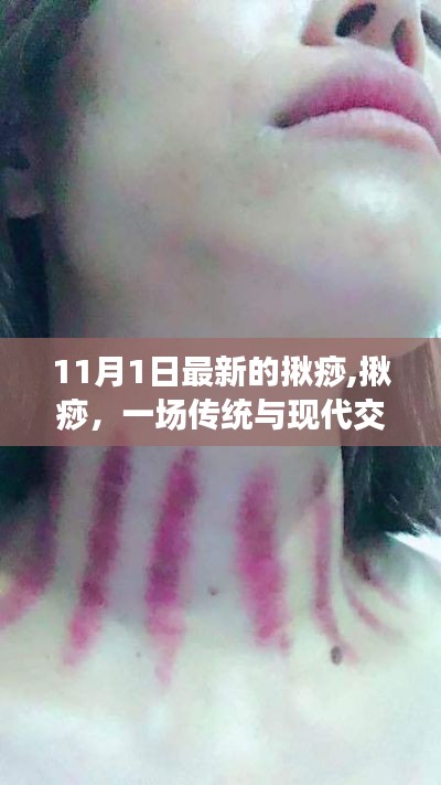 揪痧實踐之旅，傳統(tǒng)與現(xiàn)代交織的健康觀察（最新報道）