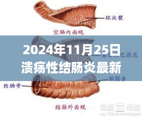 實(shí)戰(zhàn)指南，潰瘍性結(jié)腸炎最新治療辦法實(shí)戰(zhàn)步驟指南（初學(xué)者與進(jìn)階用戶適用，2024年）