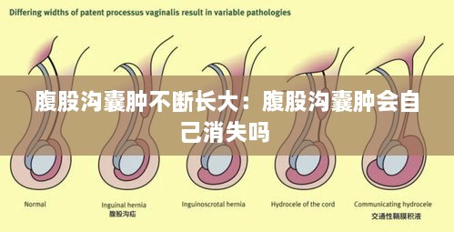 腹股溝囊腫不斷長大：腹股溝囊腫會自己消失嗎 