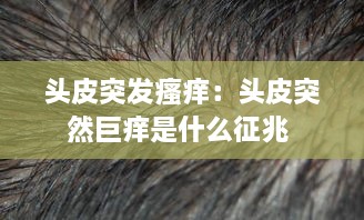 頭皮突發(fā)瘙癢：頭皮突然巨癢是什么征兆 